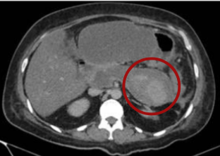 Portal venous phase contrast-enhanced abdominal computed tomography (CT) demonstrating a peripancreatic collection with a well-defined wall and adjacent peripancreatic tissue showing avid contrast enhancement.