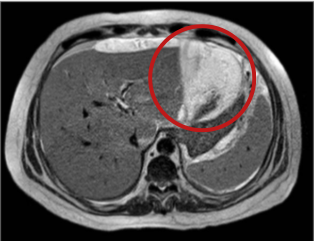 Non-contrast axial T2-weighted abdominal magnetic resonance imaging (MRI) showing a perihepatic collection with heterogeneous signal intensity and predominantly hyperintense characteristics.
