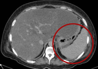 Portal venous phase contrast-enhanced abdominal CT showing a peripancreatic collection with homogeneous hypodense content and a thin, well-defined wall, causing displacement of the lesser gastric curvature.