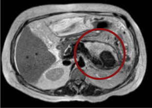 Non-contrast axial T2-weighted abdominal MRI demonstrating a peripancreatic collection with a thin, well-defined wall, heterogeneous peripancreatic tissue, and associated alteration in the morphology of the pancreatic tail.