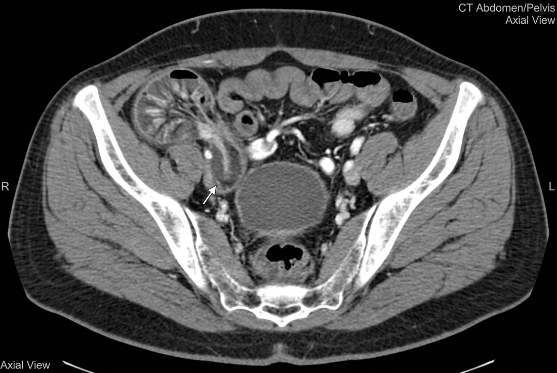 Axial pelvic CT