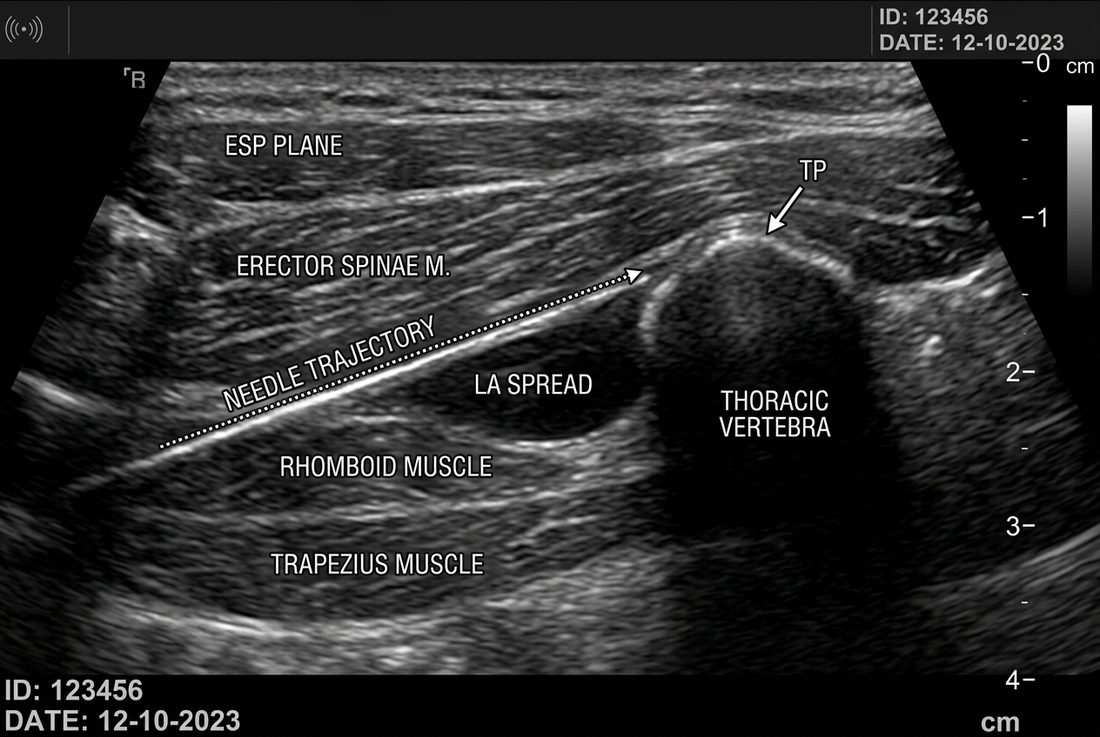 Ultrasound anatomy of the erector spinae plane block
