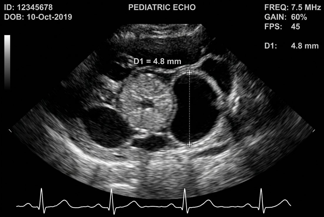 Echocardiographic coronary artery dilation