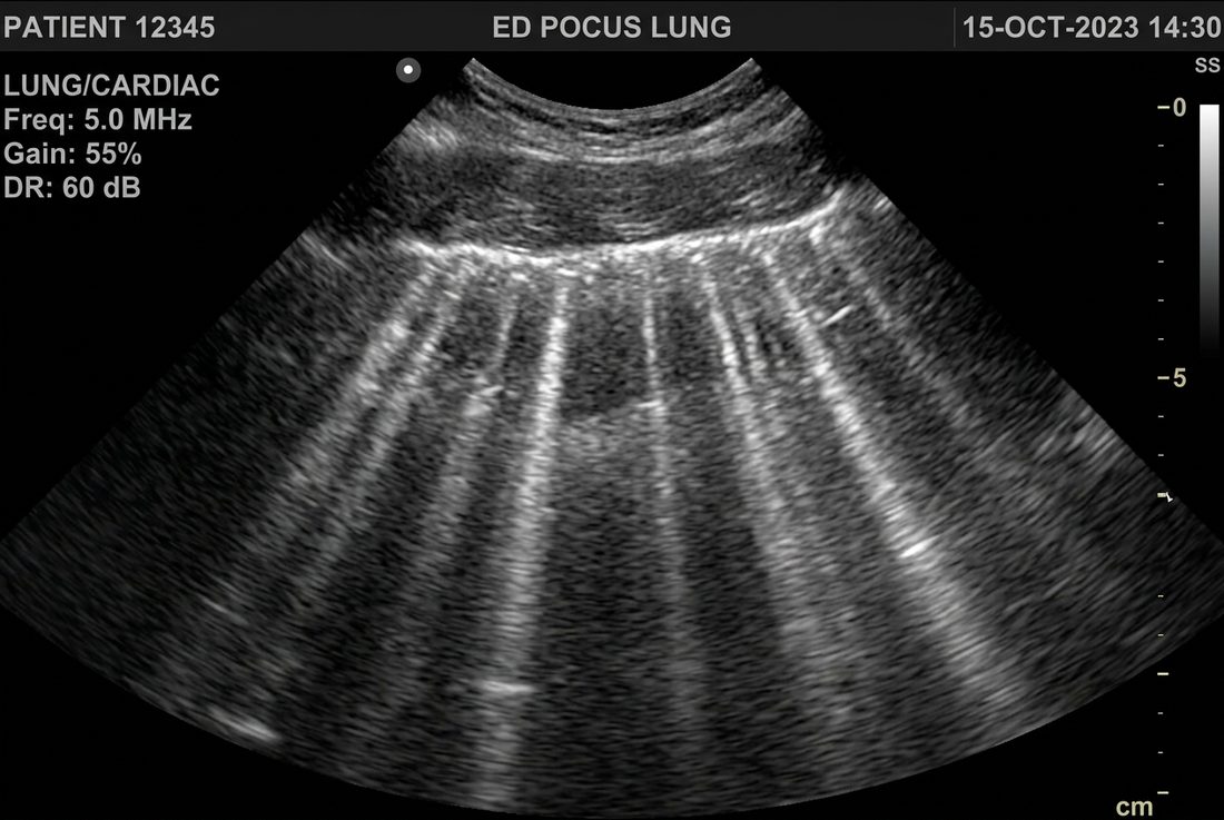 Lung ultrasound B-lines