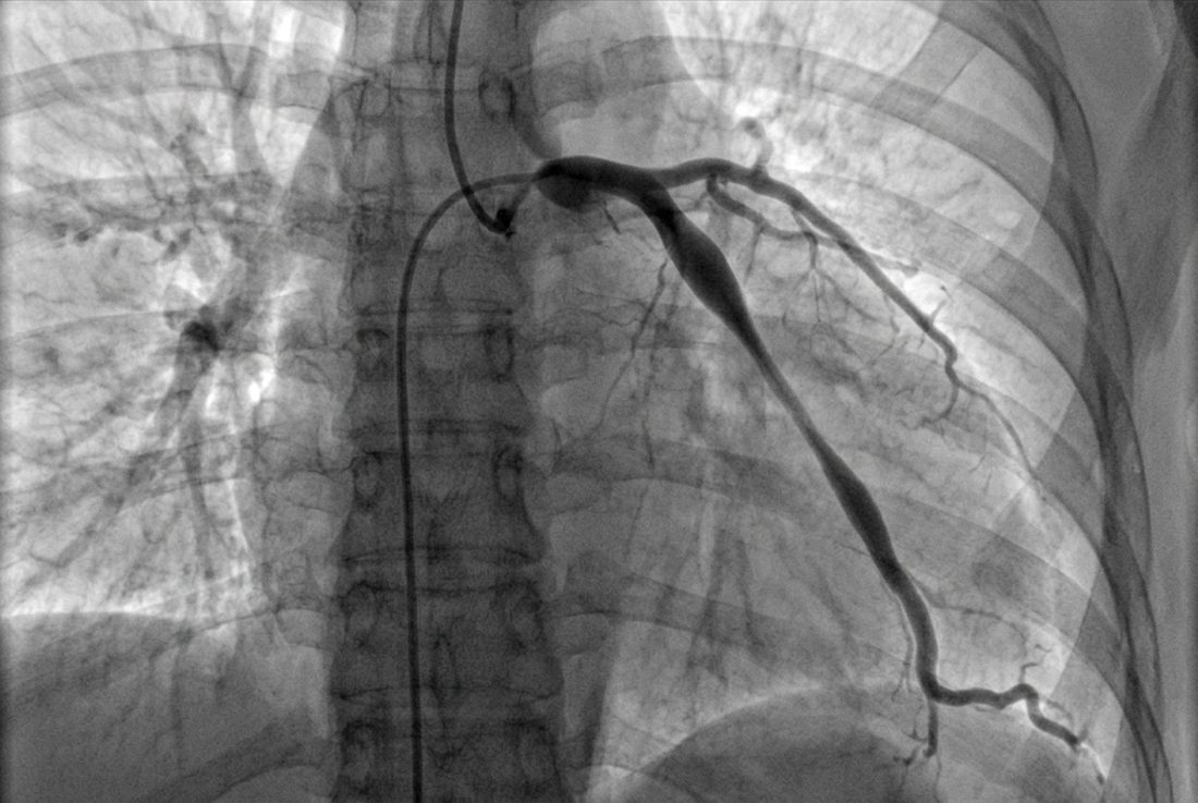 Coronary angiogram