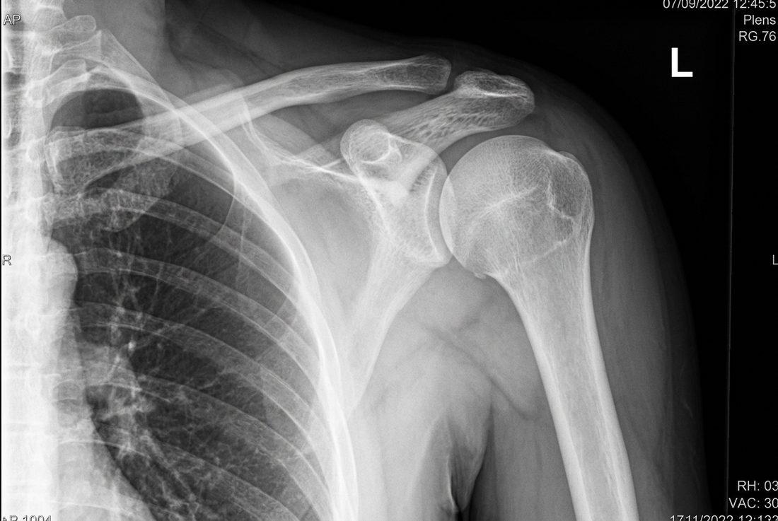 Anteroposterior shoulder radiograph