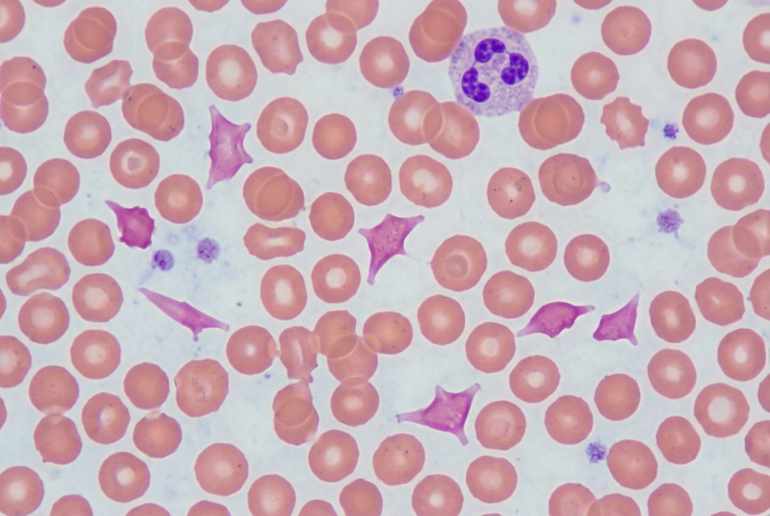 Peripheral blood smear