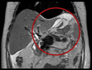 Non-contrast coronal T2-weighted abdominal MRI showing a peripancreatic collection associated with a perihepatic collection extending toward the left subdiaphragmatic space.