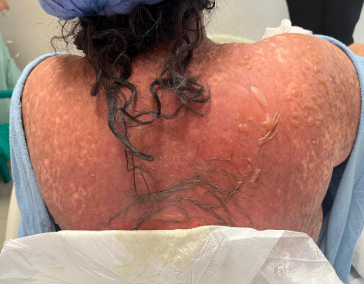 Extensive cutaneous lesions involving the dorsal region, characterized by diffuse erythema, flaccid bullae, and superficial epidermal detachment.