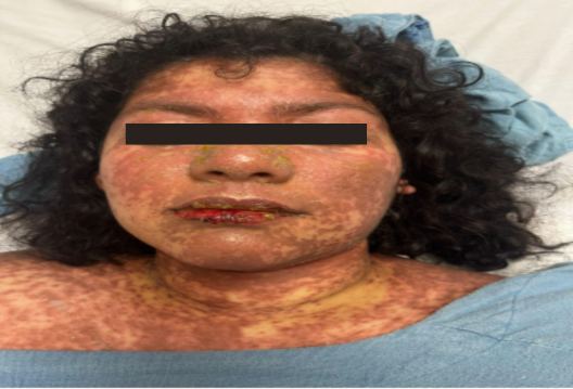 Extensive mucocutaneous lesions in a patient with Stevens–Johnson syndrome/toxic epidermal necrolysis (SJS/TEN), showing diffuse facial involvement, lip erosions, and a honey-colored crusted lesion on the nasal dorsum consistent with secondary impetigo.